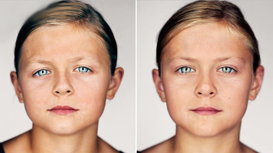 Facial asymmetry from baby flat head